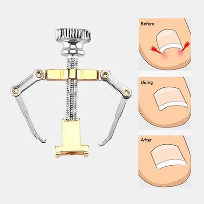 Ingrown Toenail Treatment Tool for Professional Pedicure