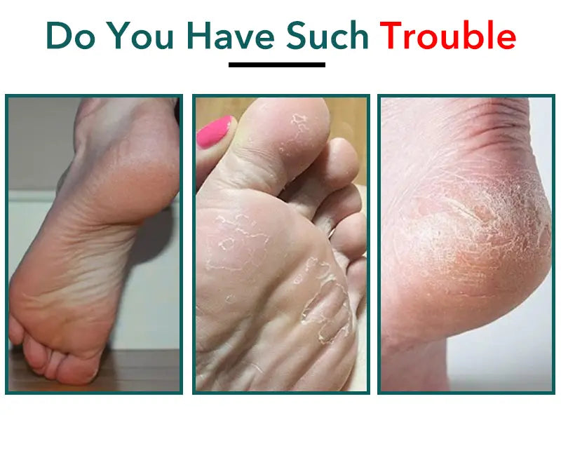 Stainless Steel Callus Remover Foot File Pedicure Tool